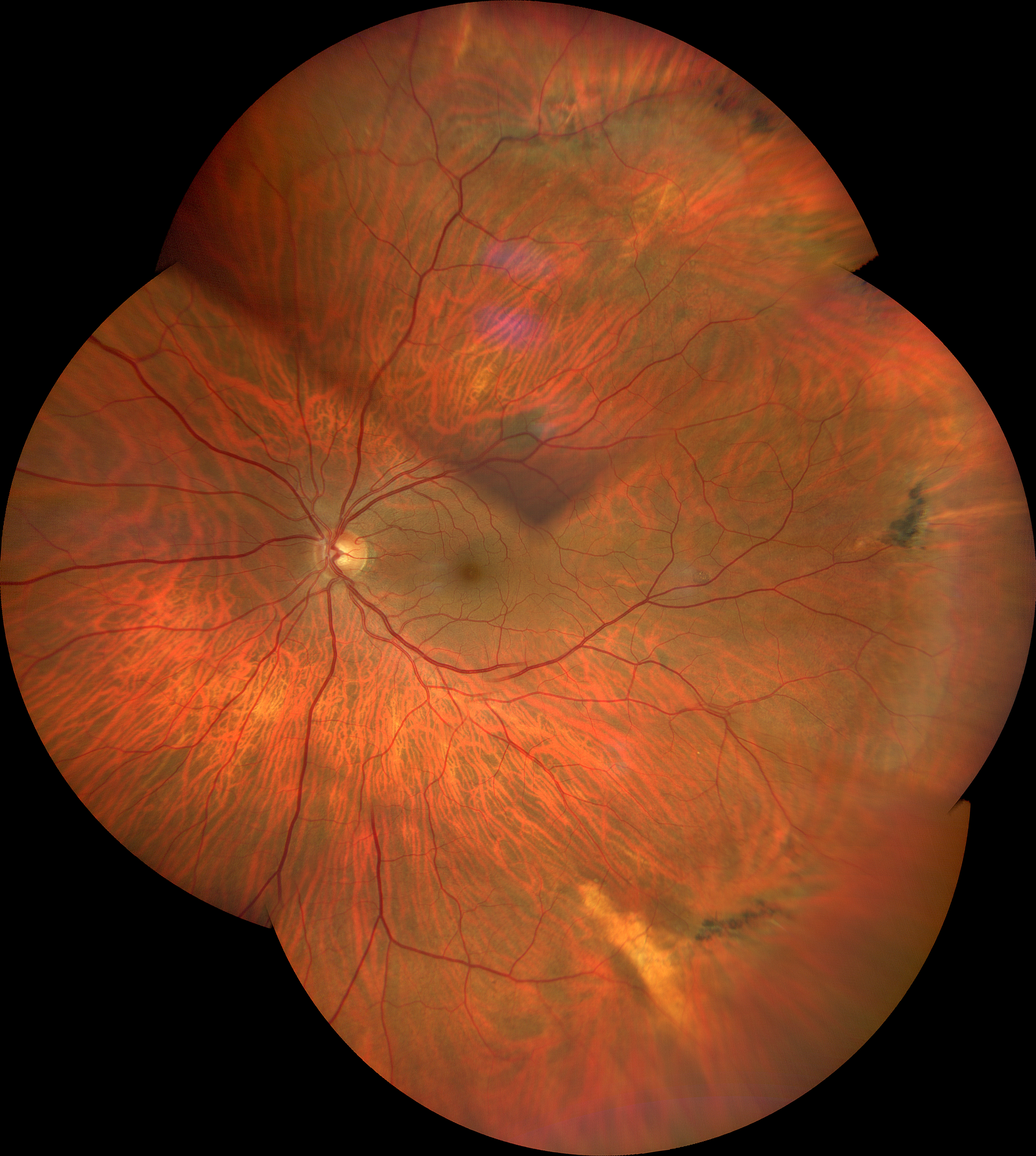 Degenerazioni retiniche periferiche